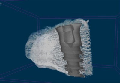 C4 Tomografía computerizada de un implante dental osteointegrado