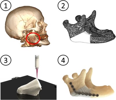 Translation of three‑dimensional printing of ceramics in bone tissue engineering and drug delivery.webp